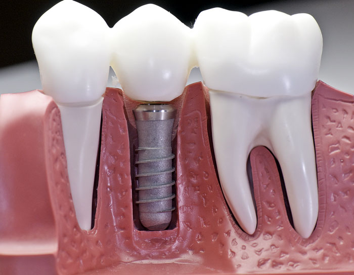 Dantų protezavimas – kad šypsotis būtų drąsiau
